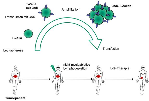 CAR-T-Zellen: Wie Designer-Immun­zellen Gegen Den Krebs Scharfgemacht ...